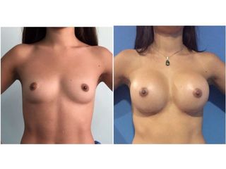 Antes y después de aumento de busto
