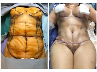 Antes y después de procedimiento estético 