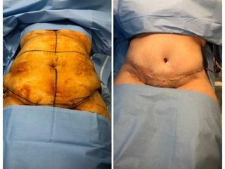 Antes y después de Lipoabdomino