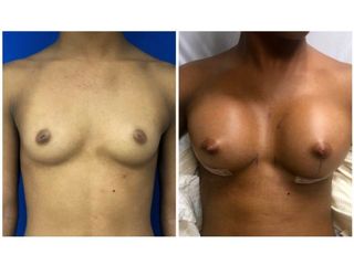 Antes y después de Implantes mamas