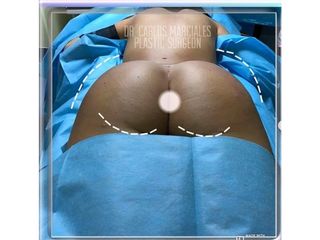 Gluteoplastia