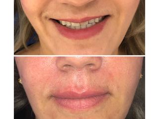 Antes y depués de aumento de labios 