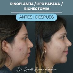 Rinoplastia - Dr. Renato Bruno Mondani