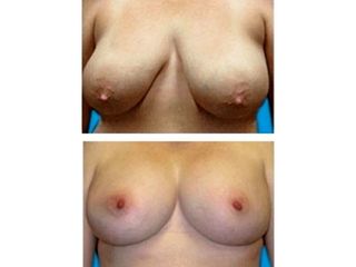 Antes y después de Reducción mamaria