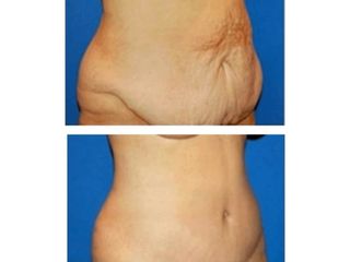 Antes y después de Abdominoplastia