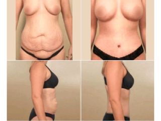 Antes y despues de abdominoplastia