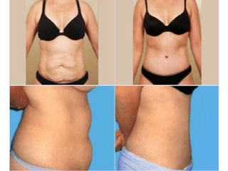 Antes y despues de abdominoplastia