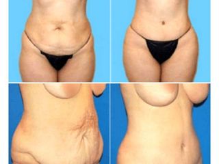 Antes y despues de abdominoplastia