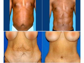 Antes y despues de abdominoplastia