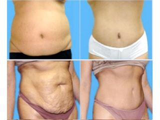 Antes y despues de abdominoplastia