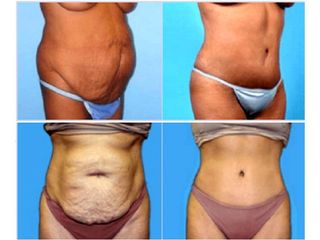 Antes y despues de abdominoplastia