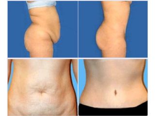 Antes y despues de abdominoplastia