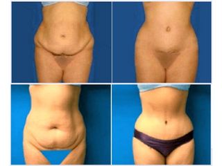 Antes y despues de abdominoplastia