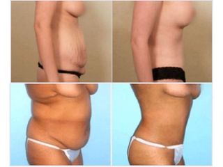 Antes y despues de abdominoplastia