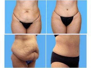 Antes y despues de abdominoplastia