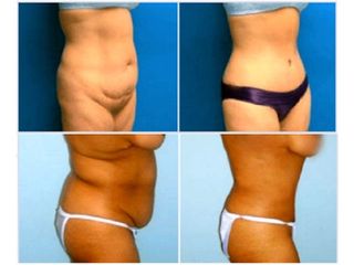 Antes y despues de abdominoplastia