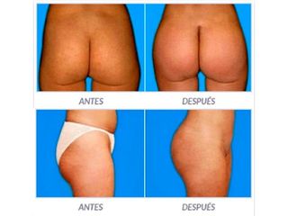 Antes y despues de gluteoplastia