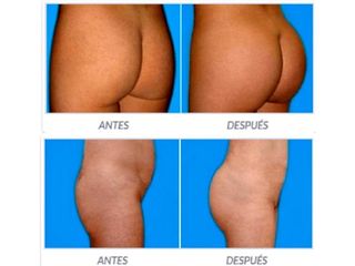 Antes y despues de gluteoplastia