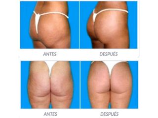 Antes y despues de gluteoplastia