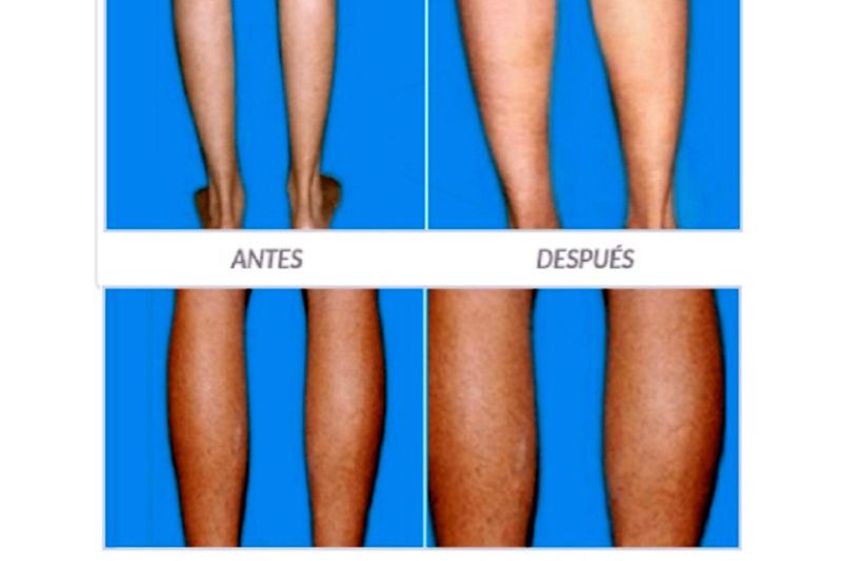 Aumento de pantorrillas antes y después - 635450