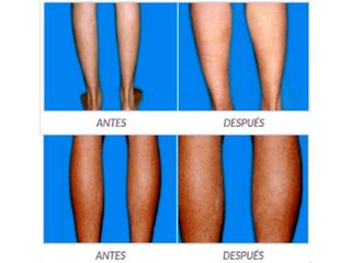 Antes y despues de implantes de pantorrillas