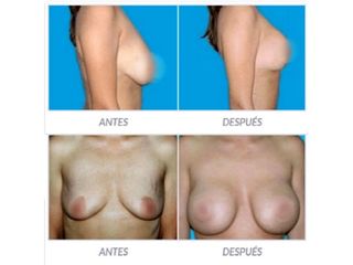Antes y despues de implantes de senos
