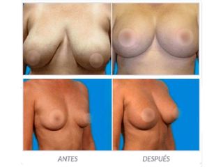 Antes y despues de implantes de senos