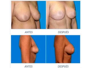 Antes y despues de aumento de senos