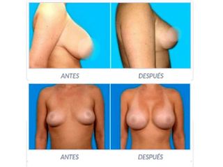 Antes y despues de aumento de senos