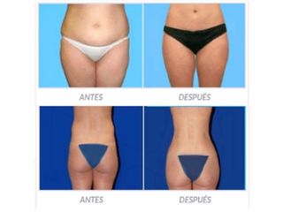 Antes y despues de lipoescultura