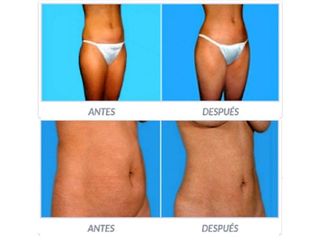 Antes y despues de lipoescultura