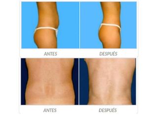 Antes y despues de lipoescultura