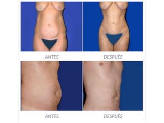 Antes y despues de lipoescultura
