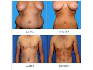 Antes y despues de lipoescultura