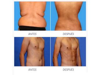 Antes y despues de lipoescultura