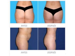 Antes y despues de lipoescultura