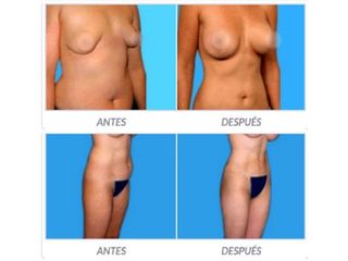Antes y despues de lipoescultura