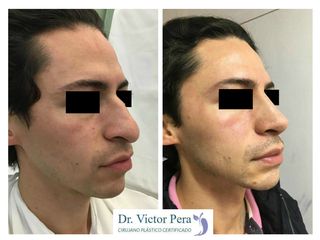 Antes y después de rinoplastia