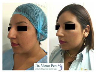 Antes y después de rinoplastia