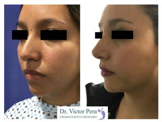 Antes y después de rinoplastia