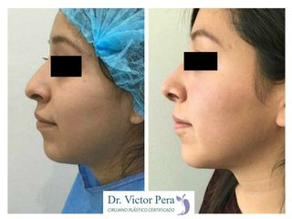 Antes y después de rinoplastia