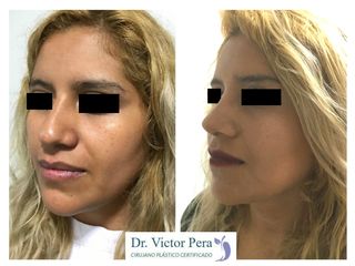 Antes y después de rinoplastia