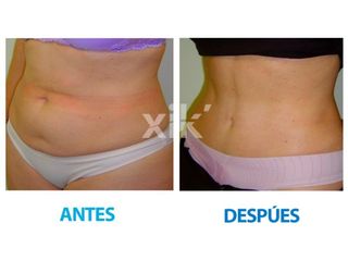 Antes y después de Abdominoplastia