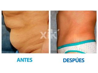 Antes y después de Abdominoplastia