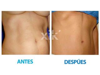 Antes y después de Abdominoplastia