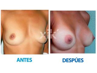 Antes y después de Aumento de busto