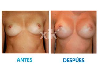 Antes y después de Aumento de busto
