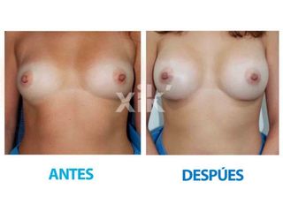 AAumento de Busto