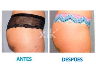 Antes y después de Gluteoplastia