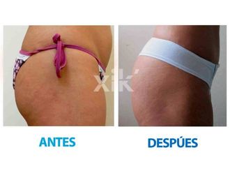 Eliminación estrías antes y después - 635995